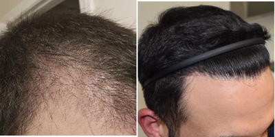 25-34 year old man treated with FUE Hair Transplant, PRP for Hair Loss, Exo-Xom - Our clients 6 month follow up, at only 50% density! Another 50% density to come over the next 6 months! Looks phenomenal, and our client is extremely happy with his results. Client had a total of 3700 grafts done, with approximately 2500 for reconstruction of the hairline, and the subsequent areas, and about 1200 grafts to add density to the crown/vertex, which was thinning and see through.