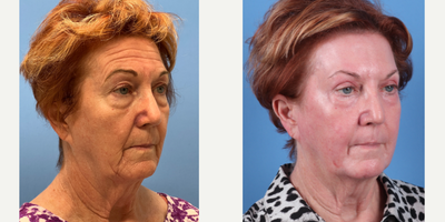 70 year old woman treated with Phenol Peel - Dr. Sam Sukkar performed a Phenol Peel on this 70 year old patient. Post-Op photos taken at just 3 months after procedure.
