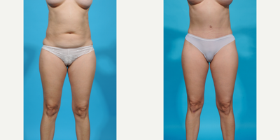 35-44 year old woman treated with Abdominal Etching, Diastasis Recti Repair, Drainless Tummy Tuck, Laser Liposuction, Liposculpt - Before and after Mommy Makeover breast augmentation. This patient wanted a breast augmentation as part of her mommy makeover. She had some volume loss, sagging, and asymmetry after multiple pregnancies. I did a dual plane breast augmentation to help the implants and breast tissue perfectly align. I used a silicone gel gummy bear SoftTouch implant sized 275cc moderate profile. She has the fullness and shape she wants and much better symmetry.