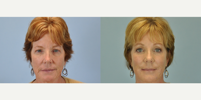 55 year old woman treated with Eyelid Surgery - This patient was treated with bilateral upper and lower blepharoplasty, bilateral canthopexy, and endoscopic brow lift.