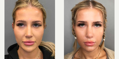 25-34 year old woman treated with Jaw Reduction - I performed an Ultrasonic Jaw Reduction using the Piezo tool. This means all incisions are made within the mouth, so no signs of surgery and has a faster recovery! See how now this patient has a more rounded tip of the chin that no longer protrudes.