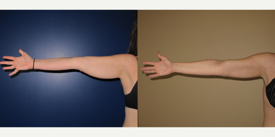 25-34 year old woman treated with BodyTite - Liposuction and Bodytite to arms