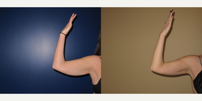 25-34 year old woman treated with BodyTite - Liposuction to arms with Bodytite