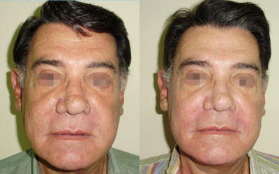 TriPollar - 
	Facial skin tightening after 6 treatments. Photos supplied by manufacturer, Pollogen Ltd, All Rights Reserved.
