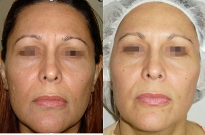 TriPollar - 
	Facial skin tightening after 6 treatments. Photos supplied by manufacturer, Pollogen Ltd, All Rights Reserved.

