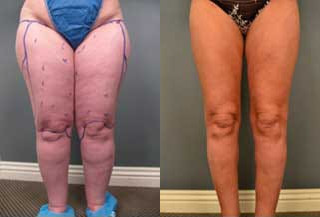 Woman treated with Lipedema Surgery - Woman treated with Lipedema Surgery