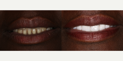 45-54 year old woman treated with All-on-4 Dental Implants - 45-54 year old woman treated with All-on-4 Dental Implants