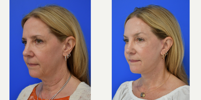 55-64 year old woman treated with Brow Lift, Facelift - Brow and neck lift on this 53 year old. She has a soft refreshed appearance and no one askes her if she is mad anymore!