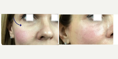 45-54 year old woman treated with Aquagold, Facial - REVIVIFY TREATMENT USING AQUAGOLD FINE TOUCH