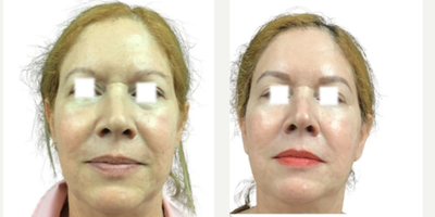 45-54 year old woman treated with Aquagold, Facial - REVIVIFY TREATMENT USING AQUAGOLD FINE TOUCH