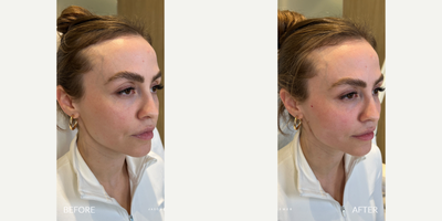 25-34 year old woman treated with Miracu, Thread Lift - Our patient recently became a mom and the lack of sleep and stress of a newborn, left her looking tired and droopy. She's here to have her face rejuvenated by our miraculous Miracu PDO Threads. These incredible threads yield the strongest hold, so they're more than up to the task of this makeover. Our patient already looks very youthful, so this is all about accentuating her existing beauty to get a natural result.