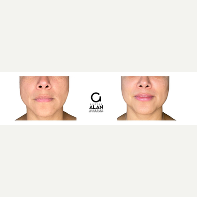35-44 year old woman treated with Dermal Fillers - The application of NCTF is performed with personalized techniques to restore or give volume and elasticity in a natural way to the skin, giving it more luminosity and eliminating dark marks and irregularities that appear on the skin. The results are progressive, they are seen from its application but after 15 days the final result is reflected.