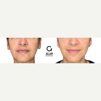 45-54 year old woman treated with Dermal Fillers - The application of NCTF is performed with personalized techniques to restore or give volume and elasticity in a natural way to the skin, giving it more luminosity and eliminating dark marks and irregularities that appear on the skin. The results are progressive, they are seen from its application but after 15 days the final result is reflected.