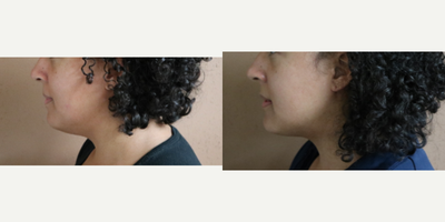 25-34 year old woman treated with Chin Liposuction - 3 months post submental liposuction under local anesthesia.