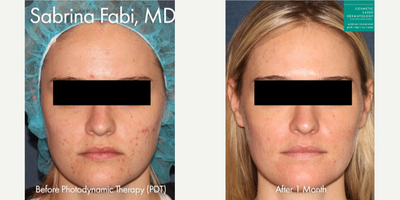 18-24 year old woman treated with Photodynamic Therapy - Photodynamic therapy used to treat acne on a female patient by Dr. Fabi.