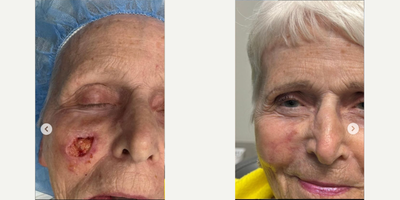 Woman treated with Mohs Surgery - Skin cancer reconstruction:Recently, I had the pleasure of seeing a patient back for her one-month follow-up after performing facial reconstruction following Mohs surgery for skin cancer on her cheek.Initially hesitant due to her age and other medical concerns, she ultimately chose to undergo treatment. She shared a heartwarming story about a special trip she took with her grandchildren after quickly recovering from surgery and expressed how grateful she was to have this issue resolved, allowing her to focus on lifes precious moments.Skin cancer is more prevalent than many realize, but when treated early, it often has the best outcomes. As a facial plastic surgeon, I frequently collaborate with dermatologists to ensure the cancer is fully removed and perform reconstruction promptly thereafter. This partnership ensures that every patient receives the best possible care. I am immensely grateful to my patients and our collaborative team for the opportunity to provide this level of care and support.