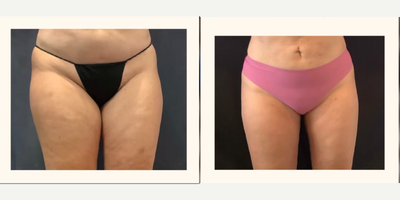 45-54 year old woman treated with SlimLipo - Smartlipo of thighs