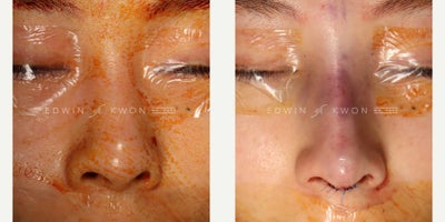 25-34 year old woman treated with Asian Rhinoplasty, DCF Rhinoplasty - 25-34 year-old woman treated with DCF rhinoplasty. Patient has had filler as well as PDO threads placed into her nasal bridge. During the time of surgery, the PDO threads were removed along with any remaining fillers. This left a significantly flat nose which was corrected with augmentation of the nasal bridge with a DCF graft. The nasal tip projection was increased and refined.