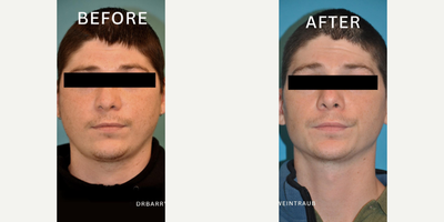 Man treated with Buccal Fat Removal - Man treated with Buccal Fat Removal as well as Chin Liposuction for slimmer face as well as defined chin, neck, and jawline.