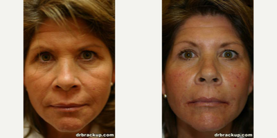 53 year old woman treated with Liquid Facelift - 53 year old women treated with fillers to full face. After photo taken immediately after procedure.