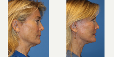 55-64 year old woman treated with Facelift, Laser Genesis, Lip Lift - This is a 62 year old female otherwise healthy with signs of facial ageing including elongation of the upper lip, skin laxity of the face and neck causing jowling, loss of the cervicomental (chin/neck) angle, platysma banding, soft tissue descent of the midface, nasolabial folds. The patient underwent deep plane facelift, lip lift. Photos are before and 5 months post op. The patient underwent post op facelift protocol including lymphatic massage, laser genesis and scar cream application to enhance/ accelerate her healing process.