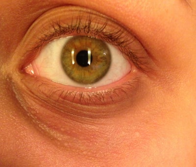 under eye wrinkles