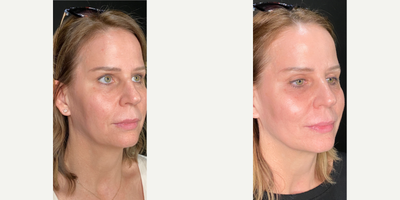 45-54 year old woman treated with Sculptra, Collagen Injection, Opus Plasma - Results after using 1 vial of Sculptra and performing one Opus Plasma treatment.