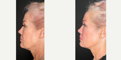 55-64 year old woman treated with Sculptra, Collagen Injection - Results after using 2 vials of Sculptra.