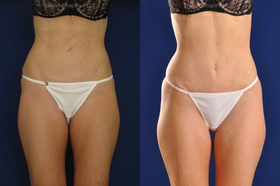Tummy Tuck Revision with Vaser Liposuction of the abdomen - 
	41 year-old-female who had a previous mini-abdominoplasty who is a self-proclaimed &ldquo;perfectionist&rdquo; and desires to treat excess skin that bundles above her belly-button and along the her tummy. She would like to look a bit &ldquo;tighter&rdquo; and curvier. Procedure: Abdominoplasty with vaser liposuction of the abdomen. Belly button was &ldquo;floated&rdquo; inferiorly to minimize the abdominoplasty scar.
