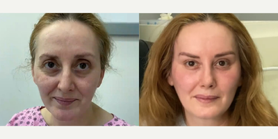 42 year old woman treated with Cheek Augmentation - 42 year old woman treated with Cheek Augmentation through facial fat transfer as well asDeep Plane Facelift,Neck Lift,Eyelid Surgery,Rhinoplasty and Brow Lift, shown 3 years post op.Pre-op, she felt annoyed and sad because of the shape of her face, making her look old. She's a mother of four and wanted to look younger and regain her self confidence.