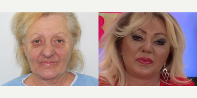 73 year old woman treated with Cheek Augmentation - 73 year old woman treated with Cheek Augmentation through facial fat transfer as well asDeep Plane Facelift,Neck Lift, Eyelid Surgery, Rhinoplasty andBrow Lift,shown 5 months post op. Patient had a dream of having a face that reflects her spirit from inside.