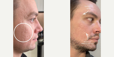 Man treated with Bellafill, Microneedling, CO2 Laser, Subcision - Man treated with Bellafill, Microneedling, CO2 Laser, Subcision