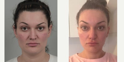 25-34 year old woman treated with AccuLift, Facial Fat Transfer, Forehead Reduction, Mini Facelift, Revision Rhinoplasty, Rhinop - .
