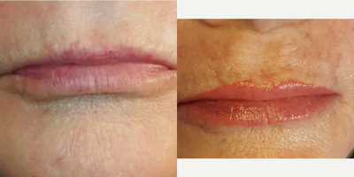 65-74 year old woman treated with Permanent Makeup - A before and after of lip blush tattoo permanent makeup by Marcy Skyer Cosmetics