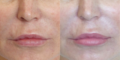 Venus Viva - Before and After 2 Treatments. &nbsp;Photos provided courtesy of Venus Concept, performed by Gregory P. Antoniak, MD.