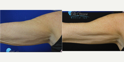 65-74 year old woman treated with Infini RF - What exactly is SkinTyte?SkinTyte is a pulsed light technology that heats deep within the skin while protecting and cooling the surface. The laser is able to accomplish this via selective thermolysis. Best of all, there is absolutely no down time.What areas can be treated?Any area of the body where an improvement to the tightness of the skin is desired can be treated.What Does SkinTyte Improve? Tightens and improves the texture and smoothness of your skin Stimulates collagen production in your skin for continued skin tightening over time Plumps and adds volume to the skin Reduces fine lines and some wrinkles around the mouth, lips and eyes Improves the definition of your jawline