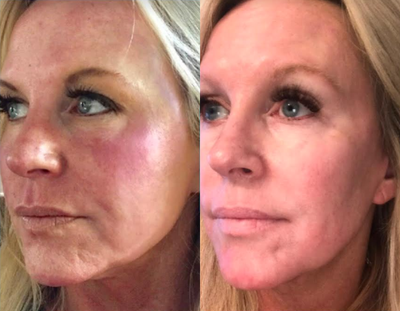 Woman treated with Aquagold - Woman treated with Aquagold