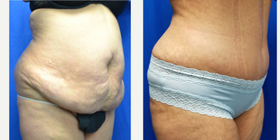 45-54 year old woman treated with Mommy Makeover - The patient is a 53 year old female two months after a tummy tuck as part of her mommy makeover. She was 5 feet 3 inches and weighed 165 lbs. before surgery. She has 3 children. Her weight after surgery is 149 lbs and she went from a size 16 to a size 10. No liposuction was done.