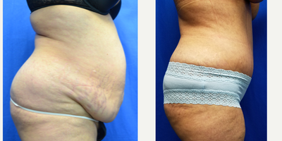 45-54 year old woman treated with Tummy Tuck - 53 year old female two months after a tummy tuck. She was 5 feet 3 inches and 165 lbs. She has 3 children. After surgery, her weight is 149 lbs and she went from a size 16 to a size 10.