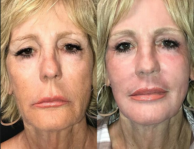 Woman treated with Renuvion - Before and 5 weeks after J-plasma.