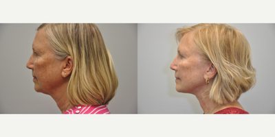 63 year old female treated with Eyelid Surgery - 63 year old woman 4 months following treatment with Facelift, Necklift, Facial Fat Grafting, and upper Blepharoplasty