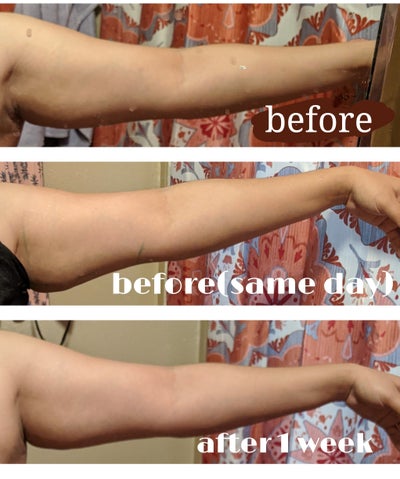 Coolsculpting for Upper Arms - Review - RealSelf