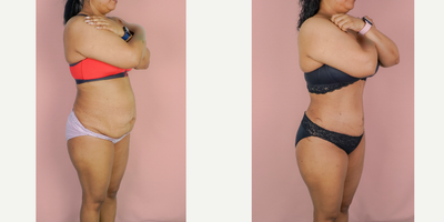 25-34 year old woman treated with Tummy Tuck, Liposuction - This patient wanted to improve the appearance of her abdomen after having children. She wanted to improve her core strength so she could get back to the activities she loved. She underwent a Tummy tuck and Liposuction and is shown 3 months after surgery.
