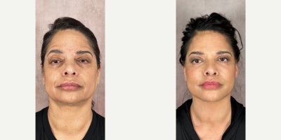 55-64 year old woman treated with The Masterpiece (Revision Deep Plane Face & Neck Lift, Facial Fat Transfer, Eyebrow Lift, Lip  - 56 year old patient. This comprehensive rejuvenation was achieved with Dr. Truesdales Masterpiece Rejuvenation. This includes: deep plane face & neck lift, facial fat transfer, endoscopic eyebrow lift, lip lift, upper blepharoplasty.The before picture was taken the day of her consultation and her after was taken 1 month post-operative. The Masterpiece is designed for patients seeking a meaningful, tailored approach to full facial rejuvenation. It includes a deep plane facelift, neck lift, fat transfer, and customized refinements based on individual anatomy.