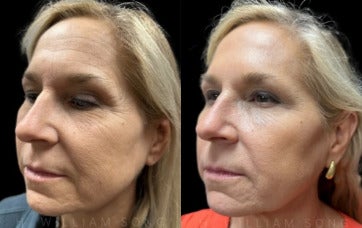 Woman treated with Dysport - Woman treated with Dysport