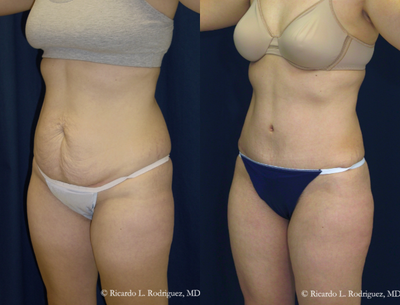 35-44 year old woman treated with Bmore butt lift Butt Lift - 35-44 year old woman treated with Bmore butt lift Butt Lift