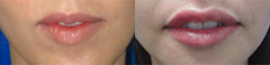 25-34 year old woman treated with Belotero - 1 syringe of Belotero to the lips.