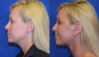 40-49 year old woman treated with CO2 Laser - 40-49 year old woman treated with CO2 Laser