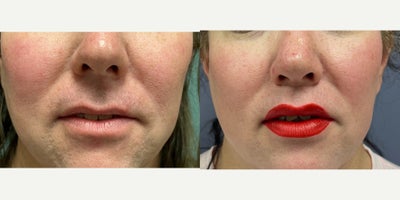 45-54 year old woman treated with Lip Lift, Lip Surgery - This young woman underwent lip surgery and augmentation.