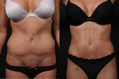Full tummy tuck revision - 
	This patient had a tummy tuck done elsewhere and desired correction and improvement of her results. A full revision tummy tuck was performed with liposuction of the flanks and abdomen. Her incision was lowered, her belly button was centered, and the underlying pseudobursa was removed.
